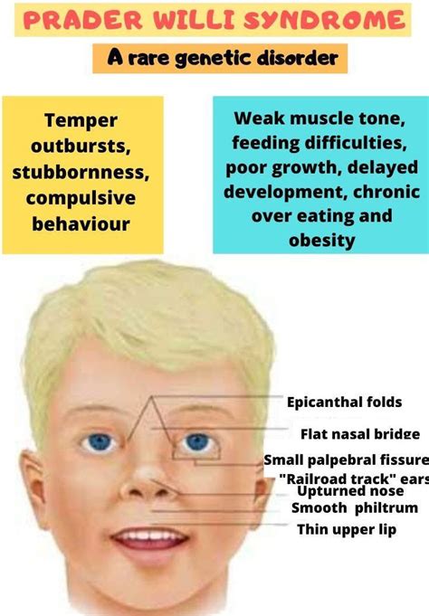 prada wilson syndrome|prader willi syndrome history.